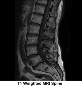 T1 Weighted MRI Spine