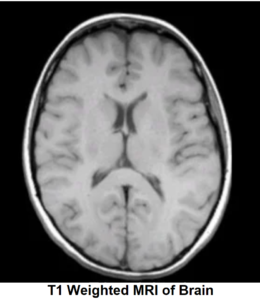 T1 weighted MRI of Brain