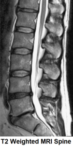 T2 Weighted MRI Spine