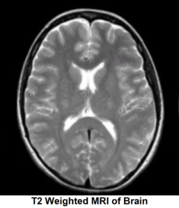 T2 weighted MRI of Brain